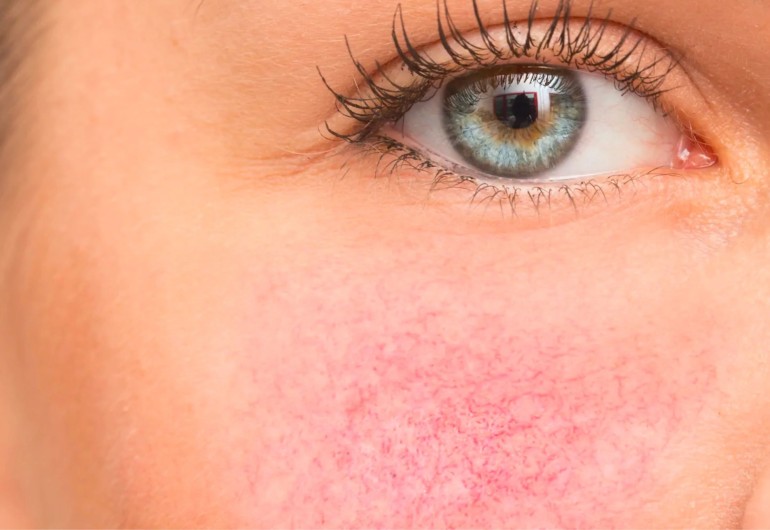 Rosacea